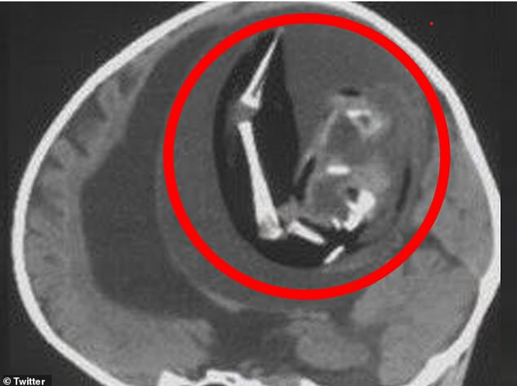 <strong>The above shows a scan of the infant girl's skull with the fetus pictured inside</strong>