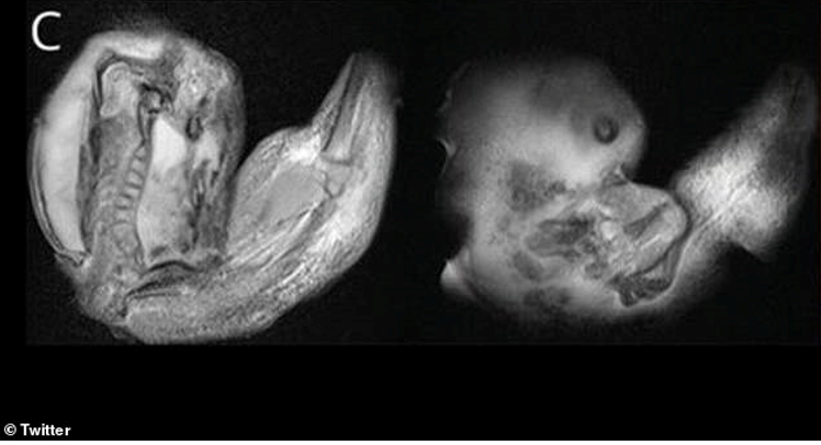<strong>Doctors said the fetus had developed upper limbs, bones and even fingernails, meaning it likely continued growing for months while inside its sibling in the womb.</strong>