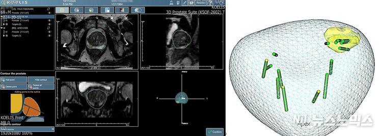 NU건전비뇨의학과 원데이 전립선 MRI 연동 표적 조직검사 결과